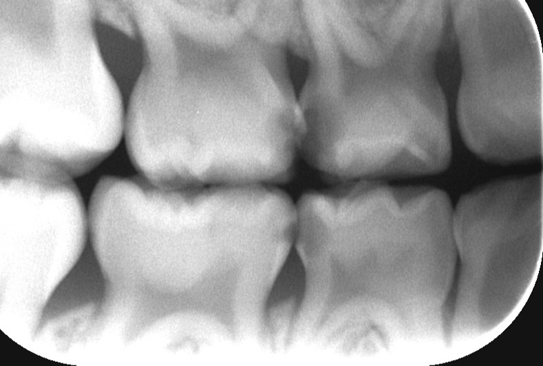 子供のう蝕率は二極化している？